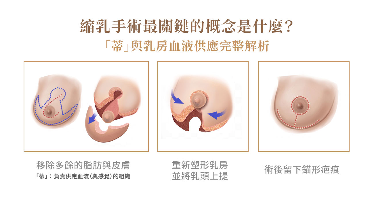 要理解倒T縮乳，必須先抓住一個核心概念，「蒂」（pedicle）。