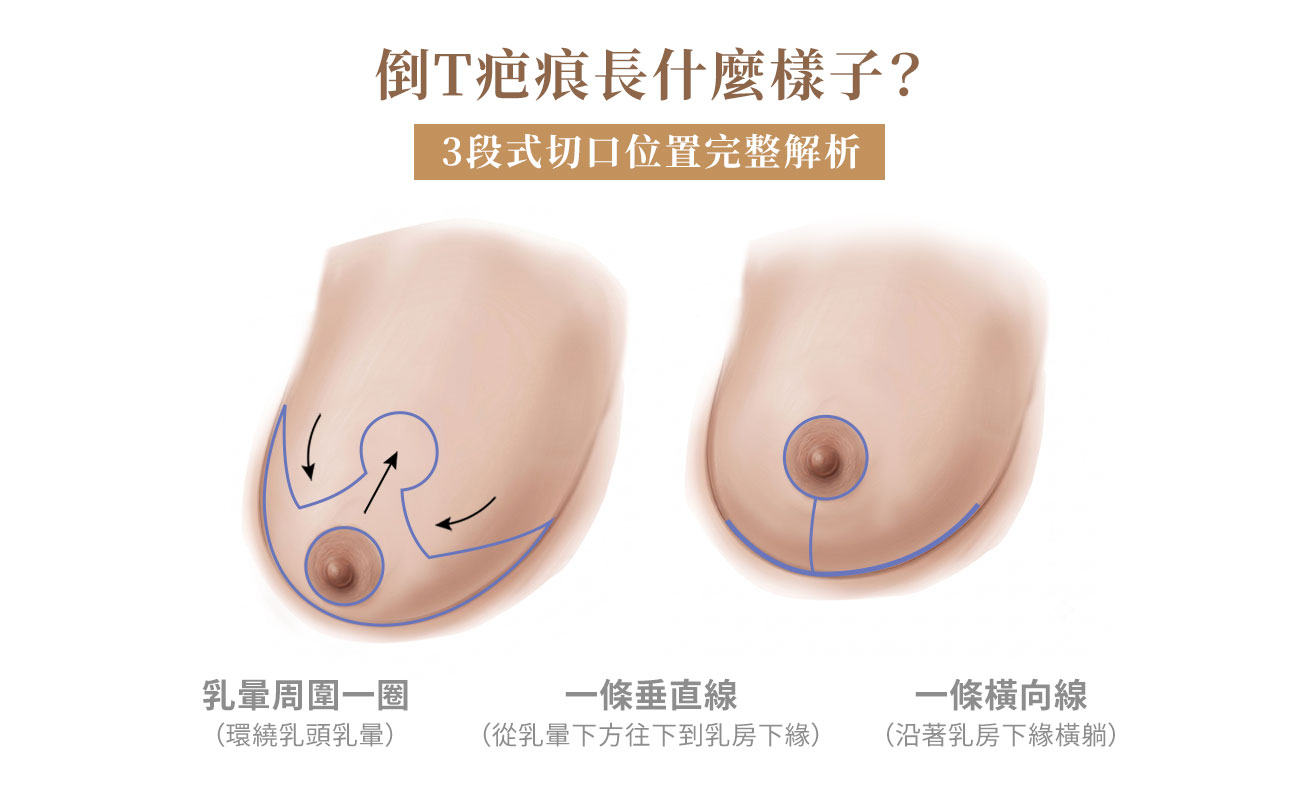 倒T疤痕長什麼樣子：乳暈周圍一圈、一條垂直線、 一條橫向線