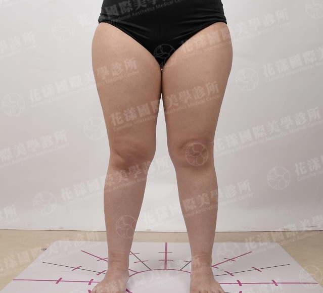 術前，個案的大腿較粗壯，走路時大腿根部經常應皮膚的磨摖而不舒服。