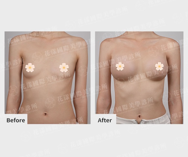 隆乳手術案例。個案產後縮乳導致胸部下垂，經醫師評估後採取內視鏡隆乳，術後經隆乳改善胸型與飽滿度。