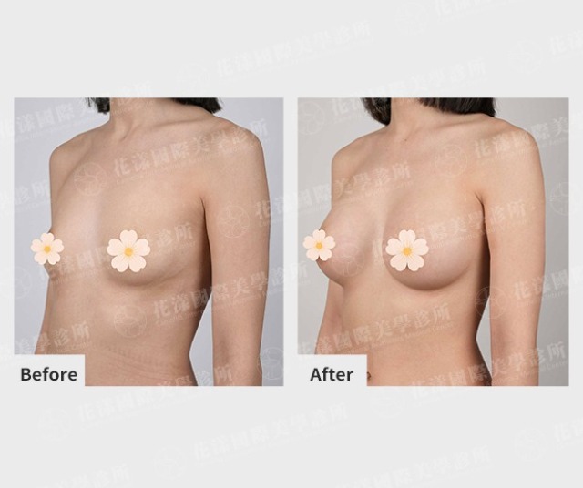 隆乳手術術前術後案例。個案屬於小胸型，經醫師評估後採取內視鏡隆乳，術後胸型更飽滿挺立。