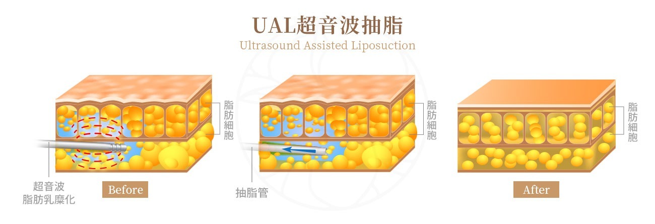 WAL(Water-Assisted Liposuction) 水刀抽脂 水刀抽脂是2000年代出現的技術。它的原理是通過從導管末端噴射出強力的水流來分解脂肪。這種手術的最大優點是對組織的損傷最小。