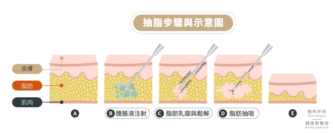 抽脂手術SAFE Lipo3步驟：1. 腫脹液注射 2.脂肪乳糜與鬆解 3. 脂肪抽吸 