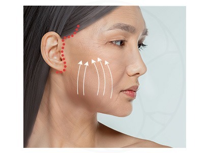 耳前切口可選擇走於耳屏（tragus）前方（pretragal），或隱藏於耳屏後方（retrotragal）。