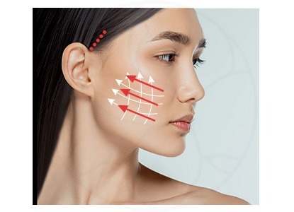 僅使用較短的耳前切口，不延伸至耳後或後枕部，適用於微創術式如 MACS lift 或 mini facelift。