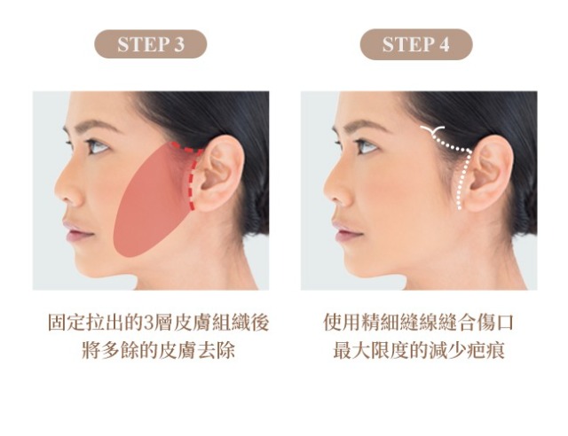3.固定拉出的3層皮膚組織後，將多餘皮膚去除4.使用精細縫線縫合