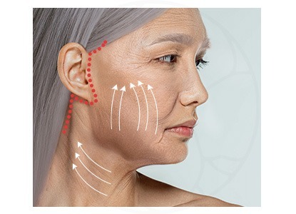 沿顳部髮際線起始，繞耳前（可走耳前緣或耳前皺褶內）&rarr; 耳垂下方 &rarr; 耳後 &rarr; 至後枕髮際線。