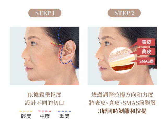 1. 依據鬆弛程設計切口2.透過調整拉提方向和力度將表皮、真皮、SMAS筋膜層同時剝離和拉提