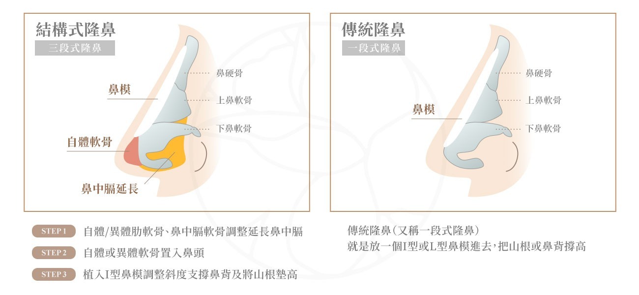 一段式、二段式、結構式隆鼻差異大比較