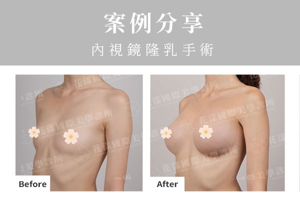 纖瘦體型內視鏡隆乳術前術後對比圖，呈現自然胸型與腋下隱痕效果