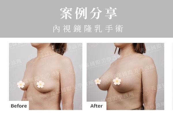 產後胸部萎縮，經錢醫師評估後選擇全程內視鏡隆乳，重提立體感胸型