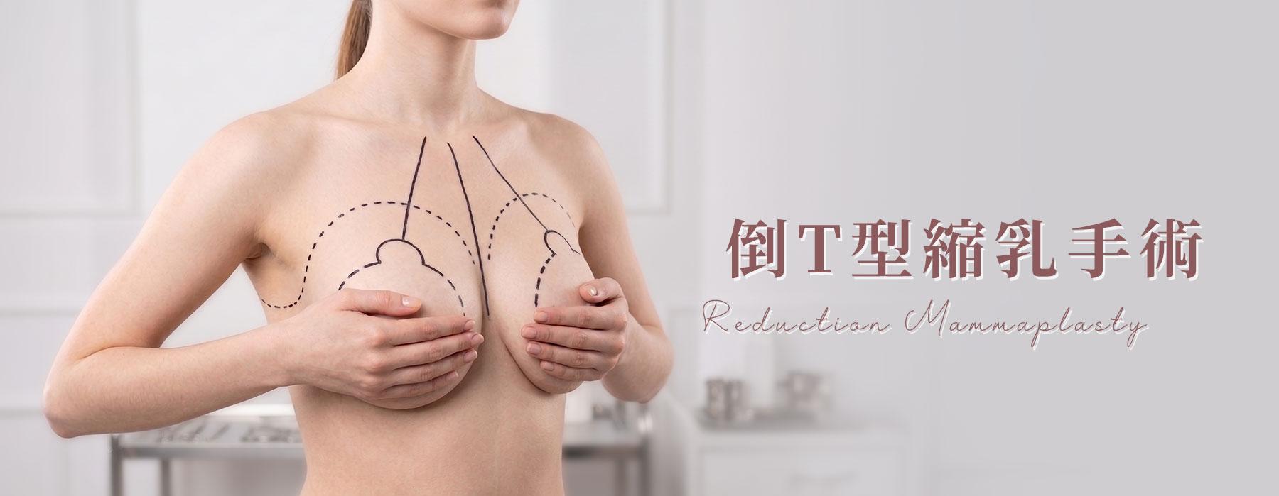 倒T型縮乳手術