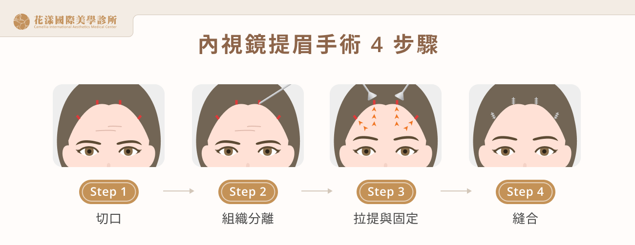 內視鏡提眉手術 4 步驟