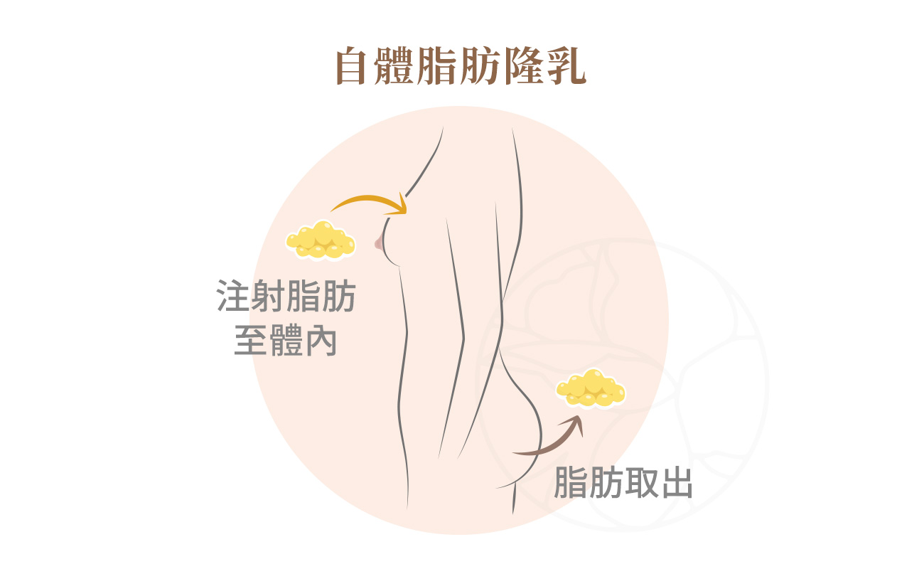自體脂肪隆乳是將身體其他部位（如腹部、大腿）的脂肪抽取、純化後注射至胸部，讓乳房自然豐盈、觸感柔軟，且幾乎沒有排斥風險。