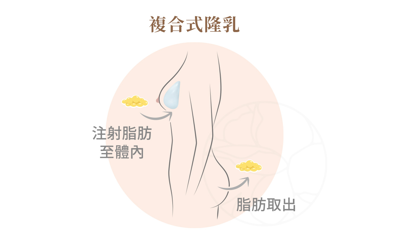 複合式隆乳結合了假體的結構支撐與自體脂肪的柔軟自然，能同時提升罩杯大小、改善胸型細節，讓整體視覺與觸感更加真實自然。