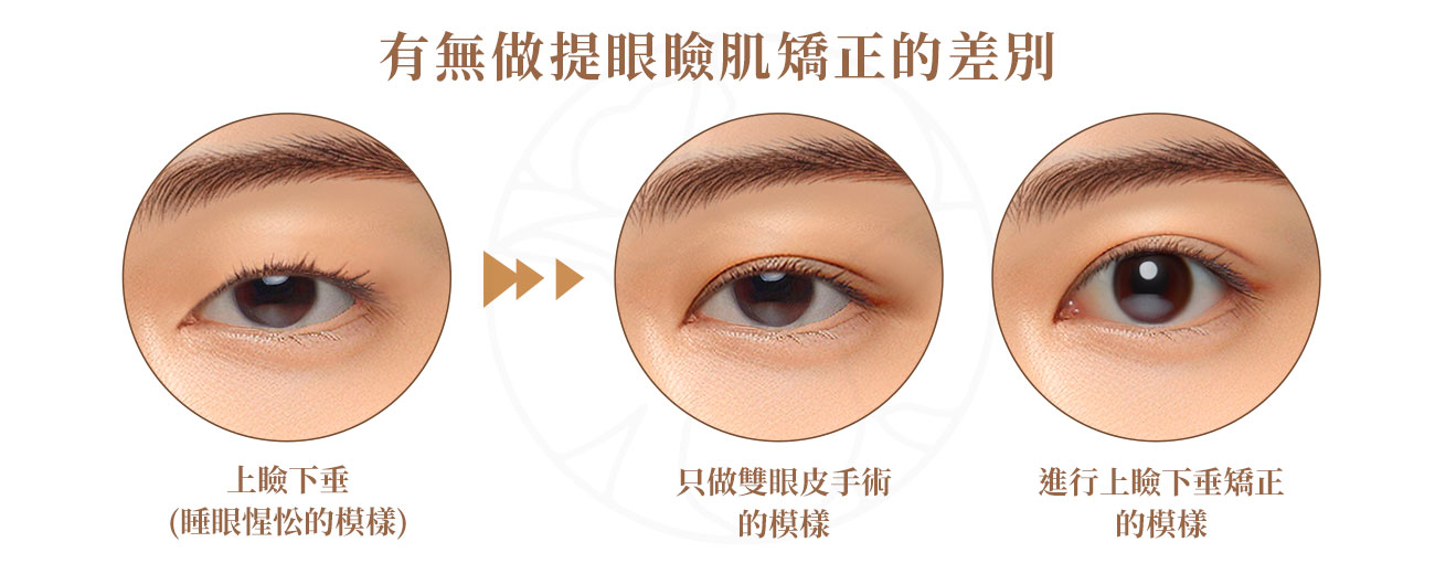 術前, 上瞼下垂, 後後 眼睛視野變大