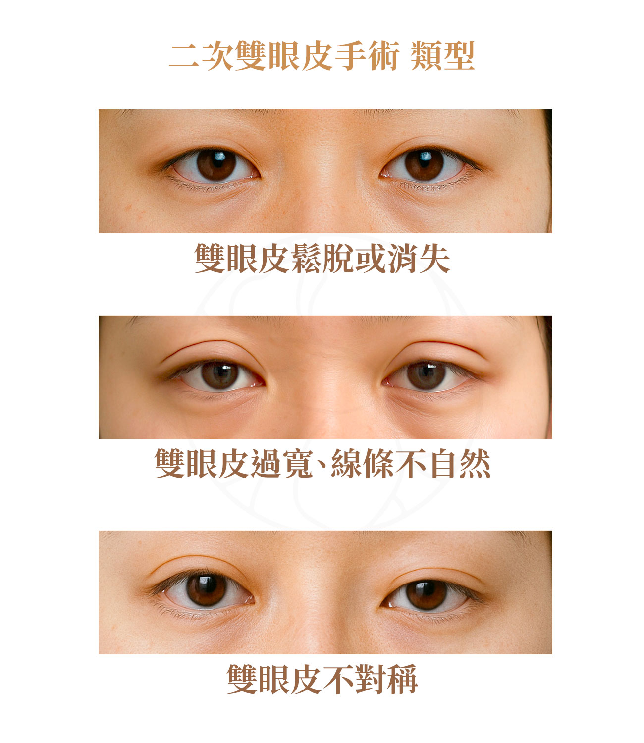 1.雙眼皮不對稱 2.雙眼皮過寬 3.雙眼皮鬆脫或消失