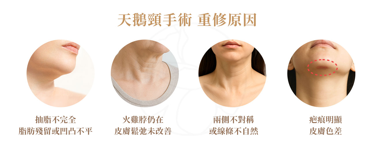 1.抽脂不完全，脂肪殘留或凹凸不平 2.火雞脖仍在、皮膚鬆弛未改善 3.兩側不對稱或線條不自然 4.疤痕明顯、皮膚色差、甚至組織攣縮 5.自然老化或生活習慣改變