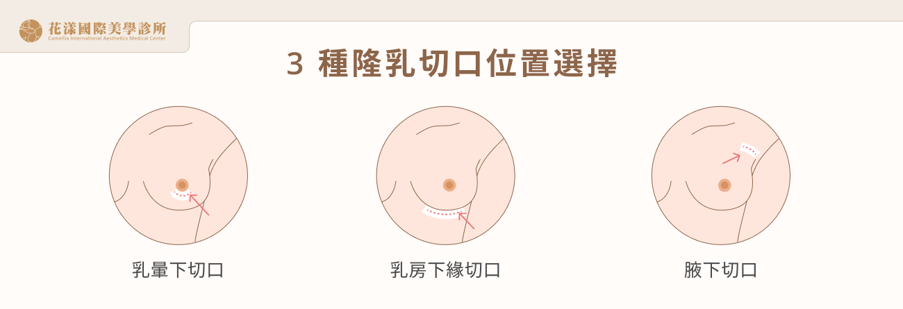 3 種隆乳切口位置選擇