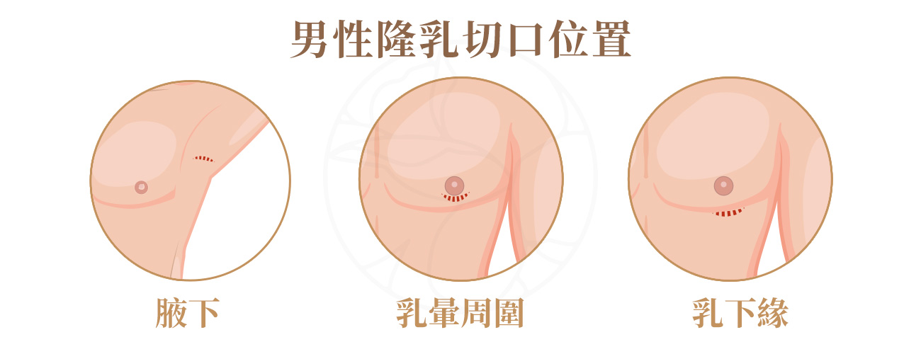 1.腋下2.乳暈周圍3.乳下緣