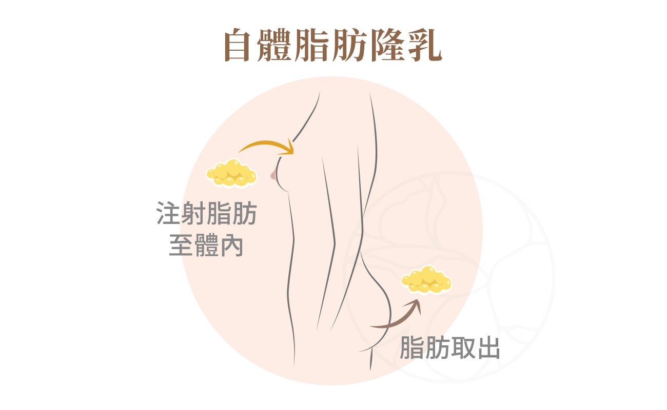 將身體其他部位（如腹部、大腿）的多餘脂肪抽取出來，經過純化後再注射到胸部。