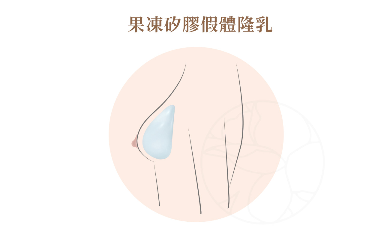 這是最常見的方式，透過植入假體(義乳)來達到胸部豐滿的效果。