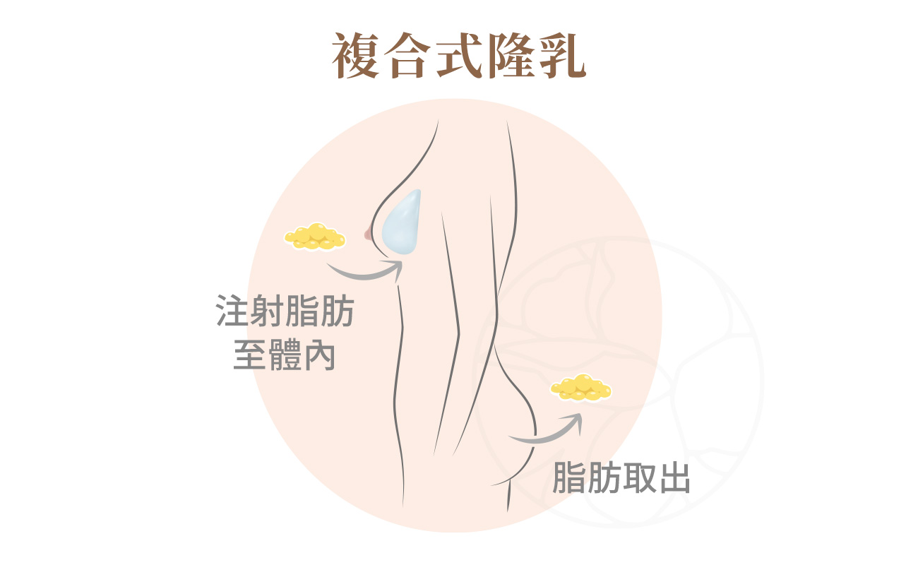 將假體的豐盈感與柔軟脂肪的優勢結合，適合希望提升罩杯又重視自然感的朋友們。
