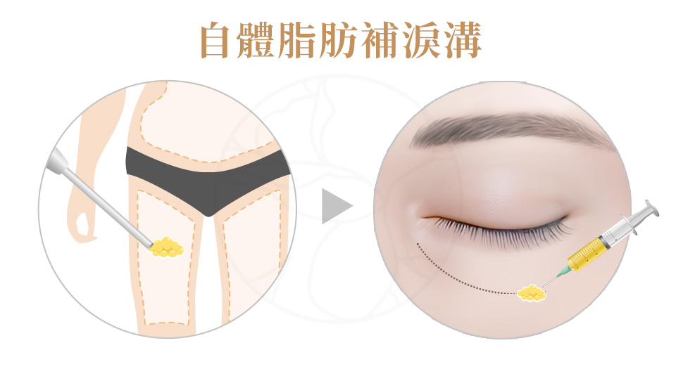 取身體脂肪（如大腿或腹部），經純化處理後注入淚溝區域，補足眼下凹陷與結構上的缺口。