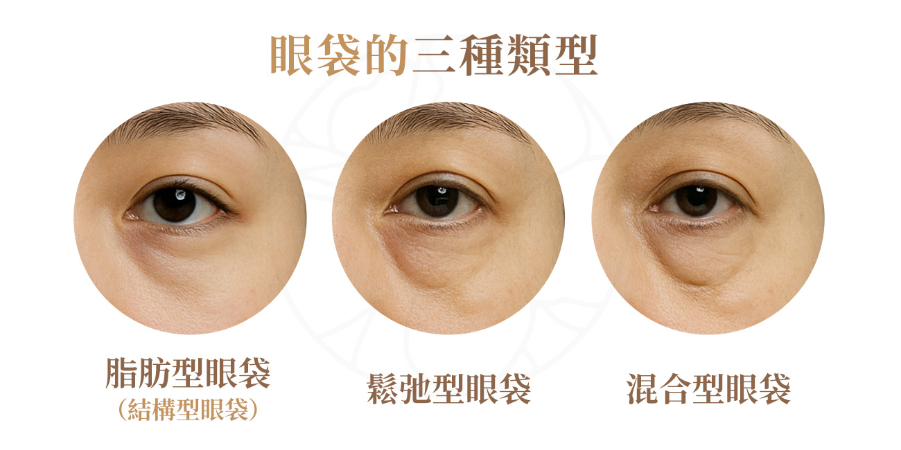 1.脂肪型眼袋（結構型眼袋）,由於眼眶內脂肪向外膨出，形成鼓起狀。2.鬆弛型眼袋, 因皮膚與眼下肌肉鬆弛、支撐力不足而造成 3.混合型眼袋, 脂肪膨出與皮膚鬆弛同時存在，這也是最常見的一種類型。
