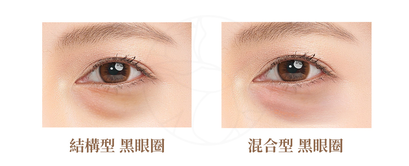 結構型黑眼圈，外觀：黑眼圈並非真正「變黑」，而是光影效果造成的暗沉。混合型黑眼圈（最常見）顏色、陰影同時存在，也是最常見、無法僅以單一方式處理的黑眼圈。