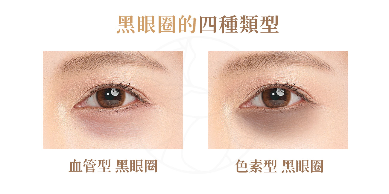 血管型黑眼圈，眼下皮膚薄透，血管更容易顯現，呈現暗藍色或紫色，尤其在燈光下更明顯。色素型黑眼圈，顏色偏棕色或灰黑色，膚色深的人較容易出現。