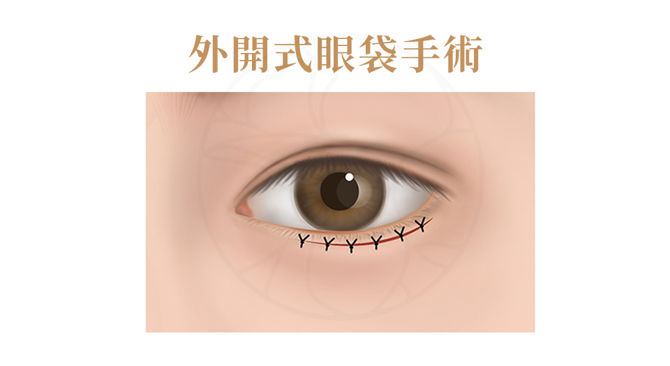 適合皮膚鬆弛者，可同時修皮、加強筋膜支撐，效果更全面。