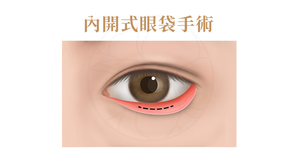 從下眼瞼內側切口取出或轉位脂肪，傷口隱痕。