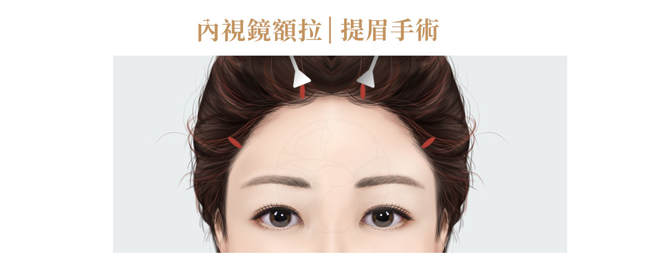 它透過高階影像技術，讓醫師在微小的4個切口下也能精準、高效率的完成拉提手術。