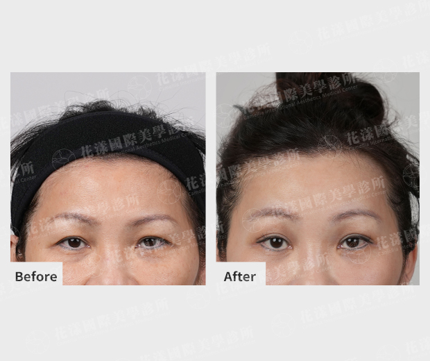 額拉提眉手術案例，個案合併眼皮下垂與眉壓眼，經醫師評估後採取內視鏡額拉／提眉手術，術後眼周開闊，改善沉重感。