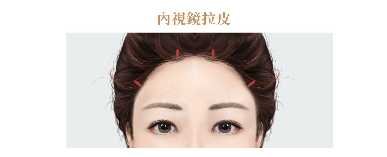 內視鏡拉皮是一種微創拉皮手術，它最大的特點是： 1.微小傷口 2.精準操作 3.恢復快 內視鏡作為手術的重要輔助，不僅能放大視野、提高手術精準度，也能提升效率並降低手術風險。