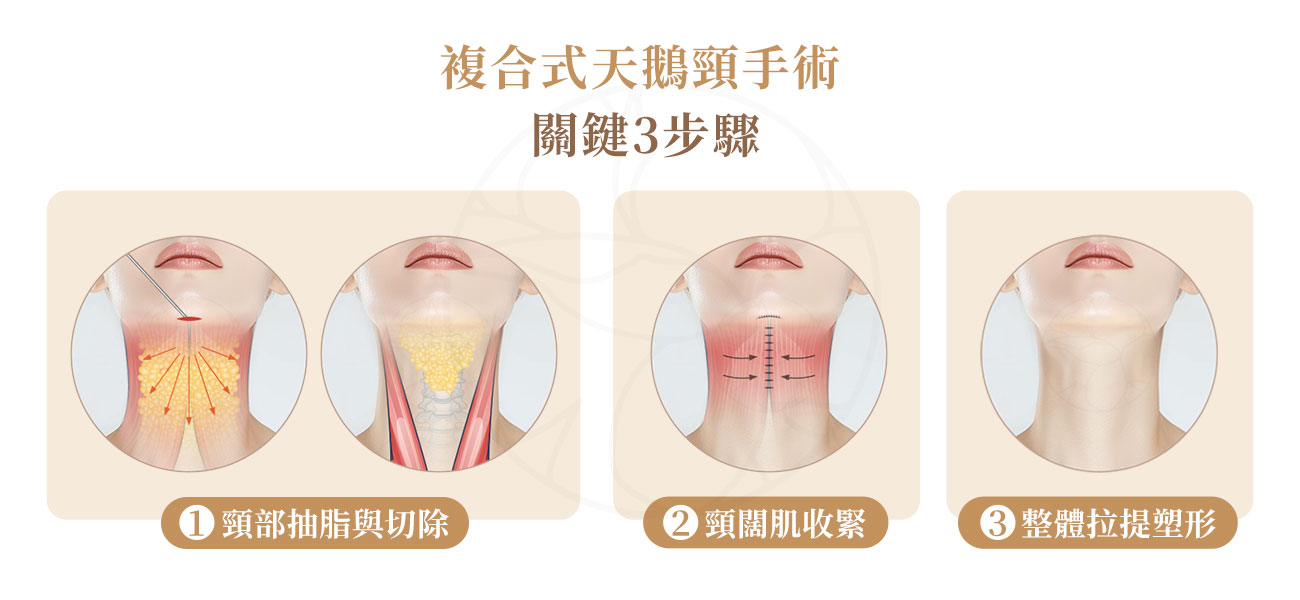 1.頸部抽脂：精準移除下巴與頸部多餘脂肪，讓下顎線清晰再現。 2.頸闊肌收緊 :從源頭處理肌肉鬆弛問題，改善「火雞脖」與下巴鬆垮感。3.整體拉提塑形：透過這兩項關鍵步驟的複合運用，徹底重塑流暢的頸部線條與下顎輪廓，從此告別視覺老態。