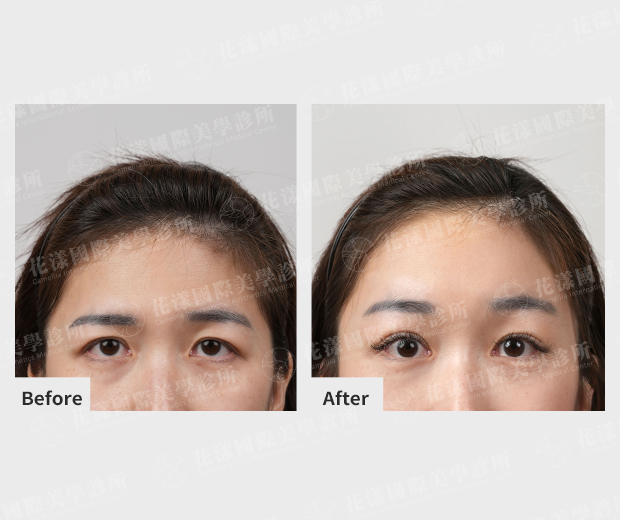 ALL_news_25J16_F2W0r5A7lC 內視鏡提眉推薦找誰?提眉手術首選「花漾國際美學診所」!