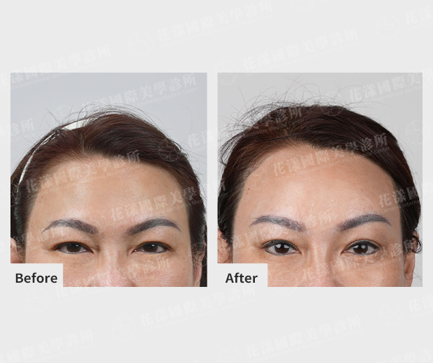 ALL_news_25J16_Gc0fH8fuHQ 隱形提眉適用對象#3 額頭鬆弛、抬頭紋明顯者