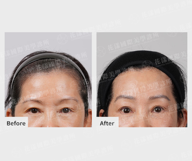 ALL_news_25J16_MTqpiWGBOO 隱形提眉適用對象#2 眉眼距離過近者