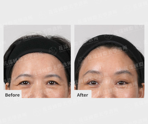 ALL_news_25J16_eYaa0xZy1F 隱形提眉適用對象#1 眉毛下垂