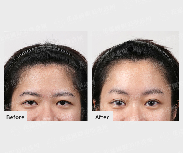 ALL_news_25J16_rLC7374r2k 內視鏡提眉推薦找誰?提眉手術首選「花漾國際美學診所」!