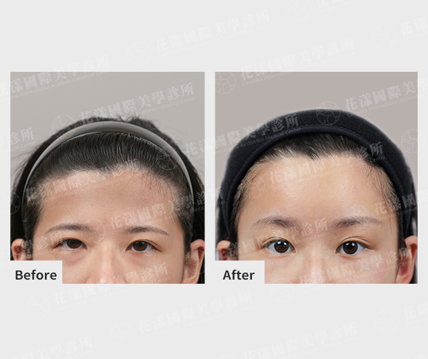 ALL_news_25J16_smwjSL9zaW 內視鏡提眉推薦找誰?提眉手術首選「花漾國際美學診所」!