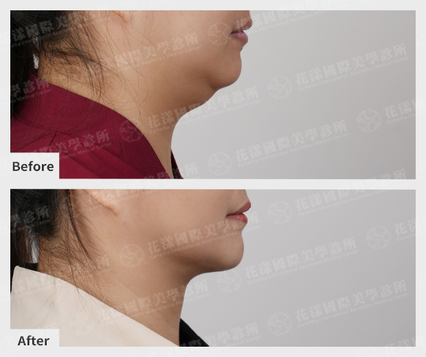 產後天鵝頸手術成功案例:改善鬆弛、雙下巴的真實術前術後對比 個案是位1寶媽。產後雙下巴特別明顯,每次拍照都要喬角度,經錢醫師評估後,選擇複合式天鵝頸手術,找回產前俐落的下顎線條。