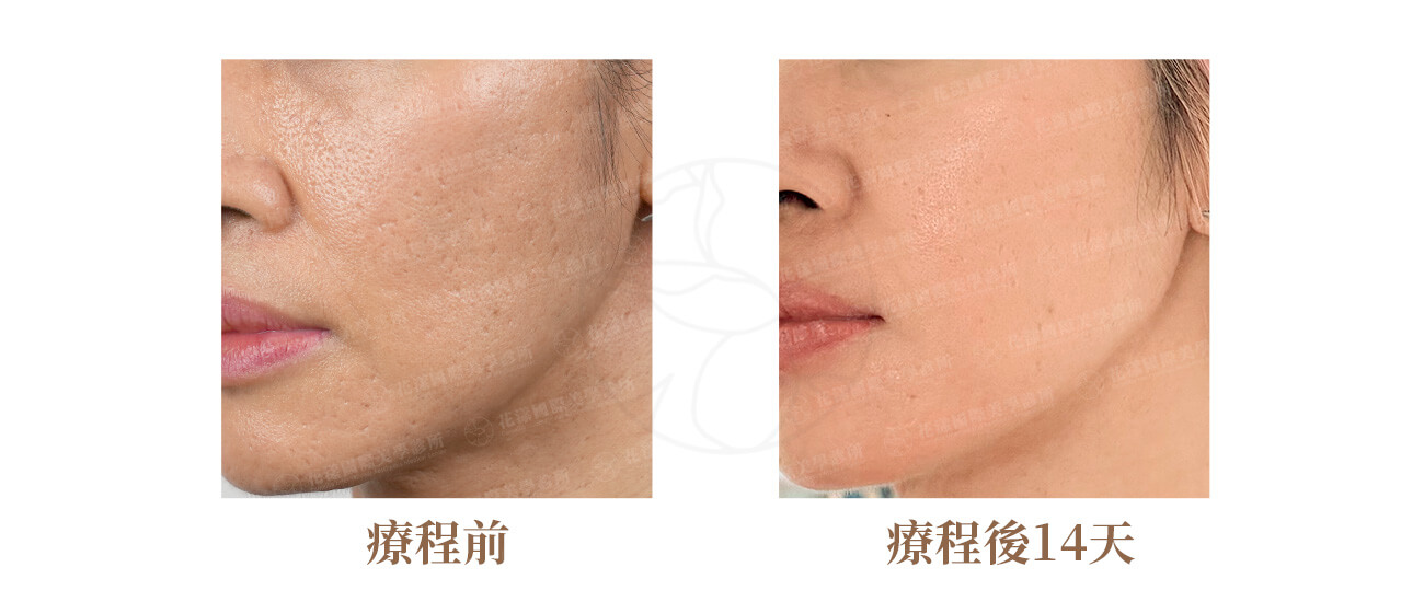 ALL_news_25J31_uL55QXS4cW 水光針案例3