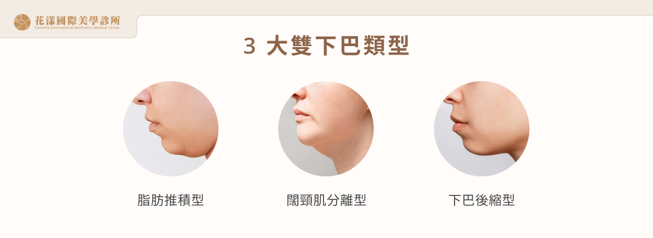 3 大雙下巴類型