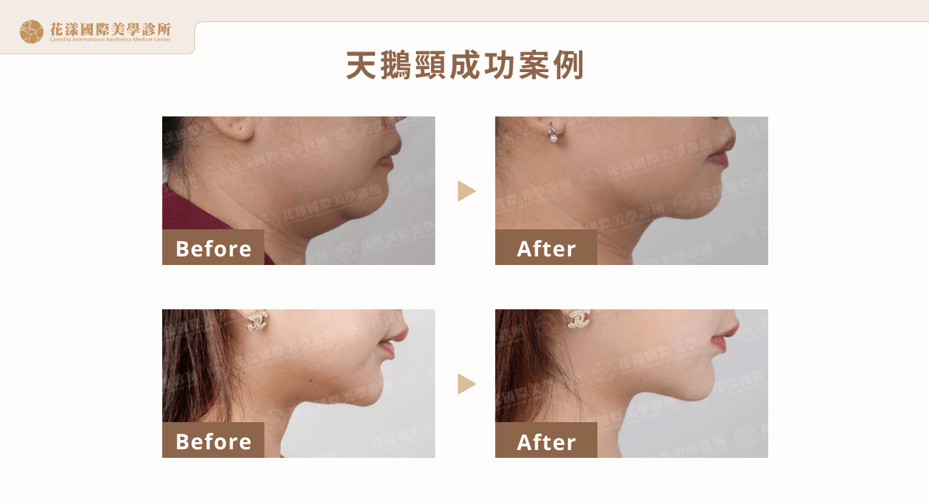 天鵝頸成功案例