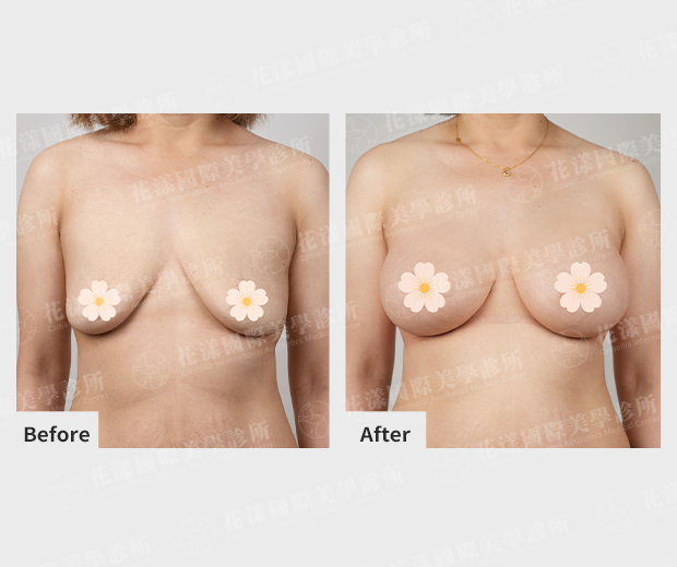 魔滴 2.0 隆乳案例1