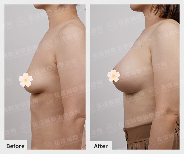 珍珠波隆乳案例2