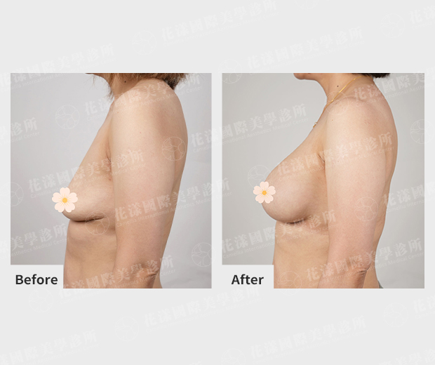 魔滴 2.0 隆乳案例2